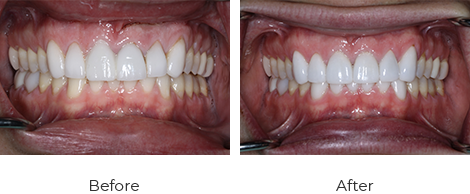Crowns Before After Case-1