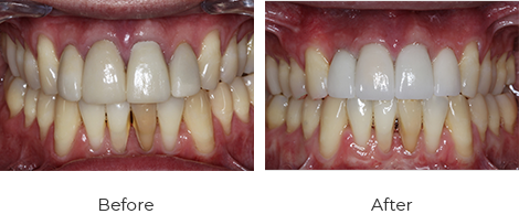 Crowns Before After Case-2
