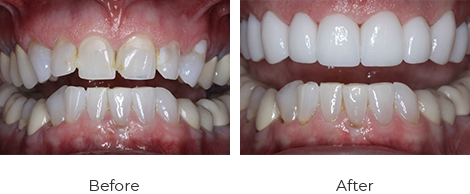 Crowns Before After Case-4