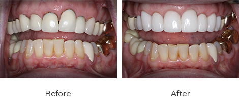 Crowns Before After Case-3