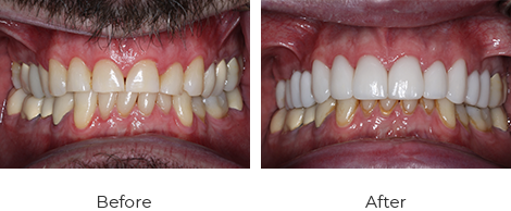 Crowns Before After Case-6