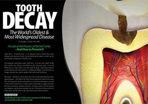 Tooth Decay — A Preventable Disease