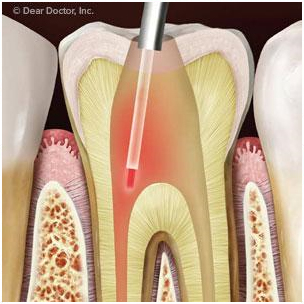 Lasers Beginning to Change Some Root Canal Procedures