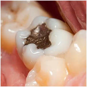 Metal Dental Amalgam Still a Safe and Effective Tooth Filling