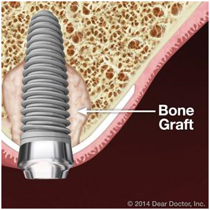 Regenerating Lost Bone Can Make Dental Implants a Reality