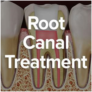 Root Canal Treatment Alleviates Pain and Saves Your Tooth