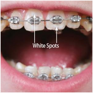 Stop White Spots Before They Appear While Wearing Braces