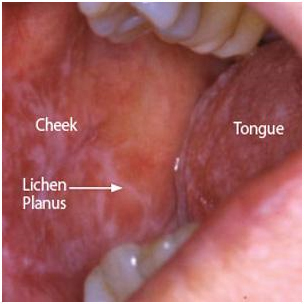 That Odd Looking Sore in Your Mouth is No Cause for Alarm