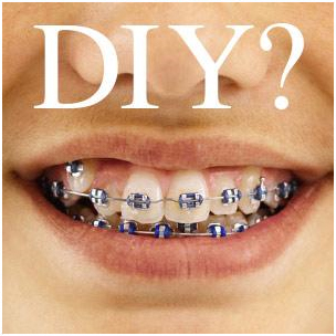 The Dangers of DIY Braces