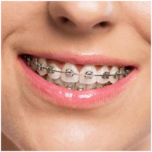 Understanding the Aging Process Leads to More Effective Orthodontics