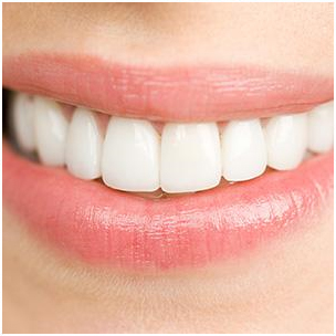 What You Should Know About Veneers for Teenagers