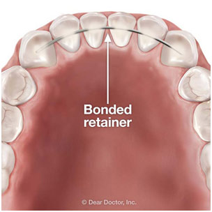 Bonded Retainer