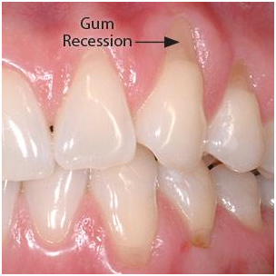 Cosmetic Gum Surgery