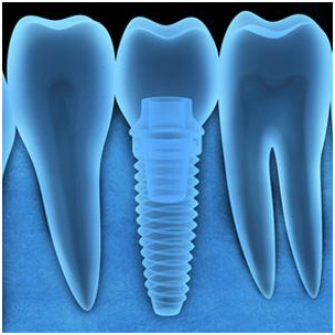 Dental Implants