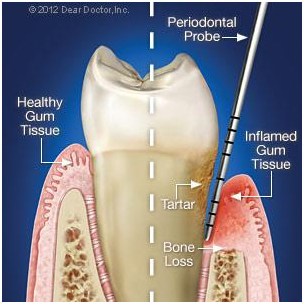 Periodontal Disease