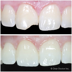 Transform Your Tooth's Appearance