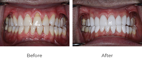 before-after-3