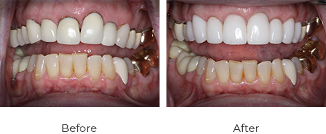 before-after-4