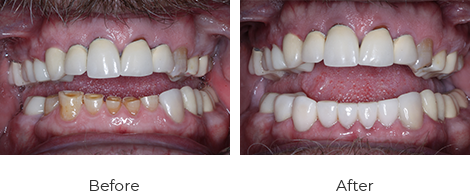 before-after-6