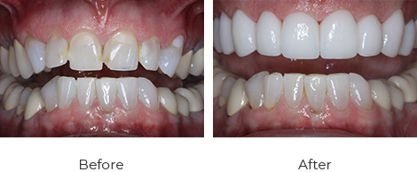 before-after-7