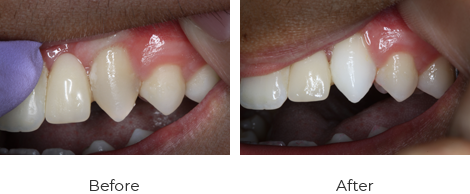 internal-bleeching-1