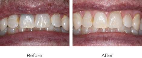 internal-bleeching-2