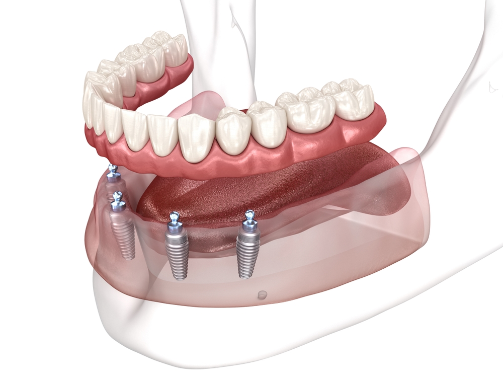 Implant Restorations cedar hills